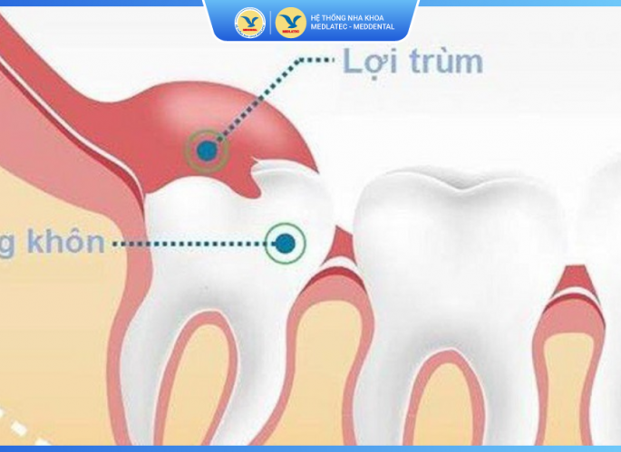 Cắt lợi trùm